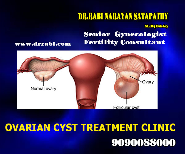 best ovarian cyst treatment clinic in bhubaneswar near kar hospital